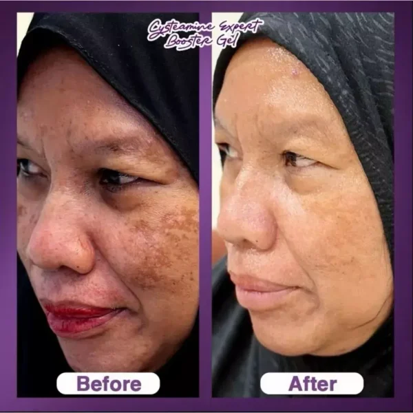 2PCS Salep Flek Cysteamine Expert Booster Gel
